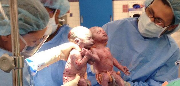 【生命の神秘】双子の赤ちゃんが手をつないだまま誕生！ まんまみーあ